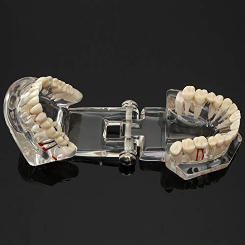 Modelo de dientes de enfermedad de implante dental con puente de restauración Modelo de ortodoncia de maloclusión para ciencia médica dental