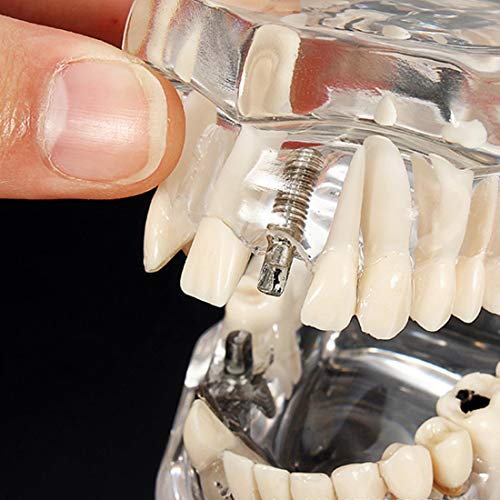 Modelo de dientes de enfermedad de implante dental con puente de restauración Modelo de ortodoncia de maloclusión para ciencia médica dental